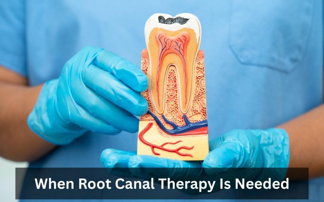 When Root Canal Therapy Is Needed