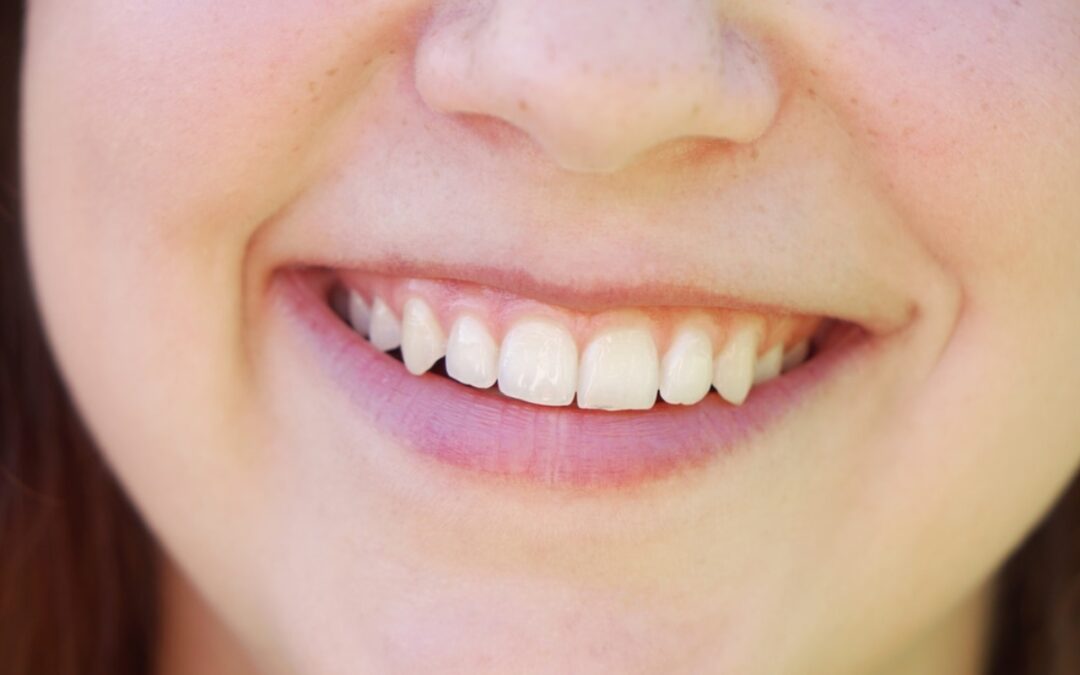 How To Get Whiter Teeth Without Compromising Your Enamel