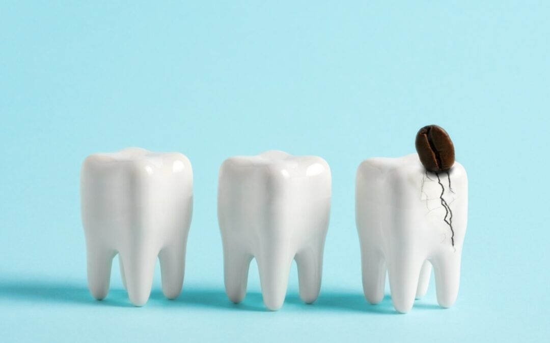 Why Early Treatment Of Cracked Teeth Matters