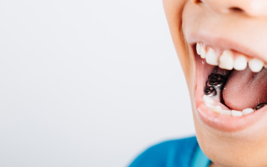 How to Protect Your Molars with Dental Sealants