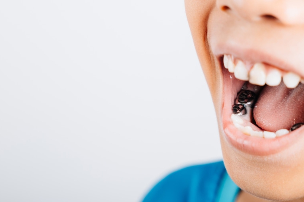 Dental Sealants in Bastrop