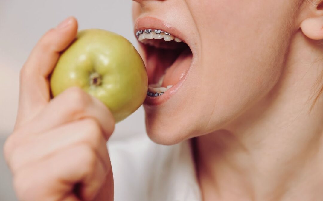Can You Eat Normally Right After Getting Braces?