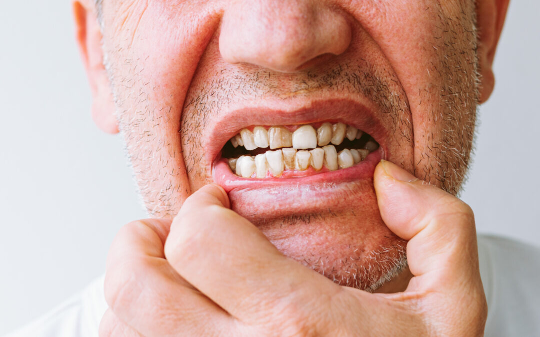 What Causes Dark Spots on Teeth and How Can a Cosmetic Dentist Fix Them?