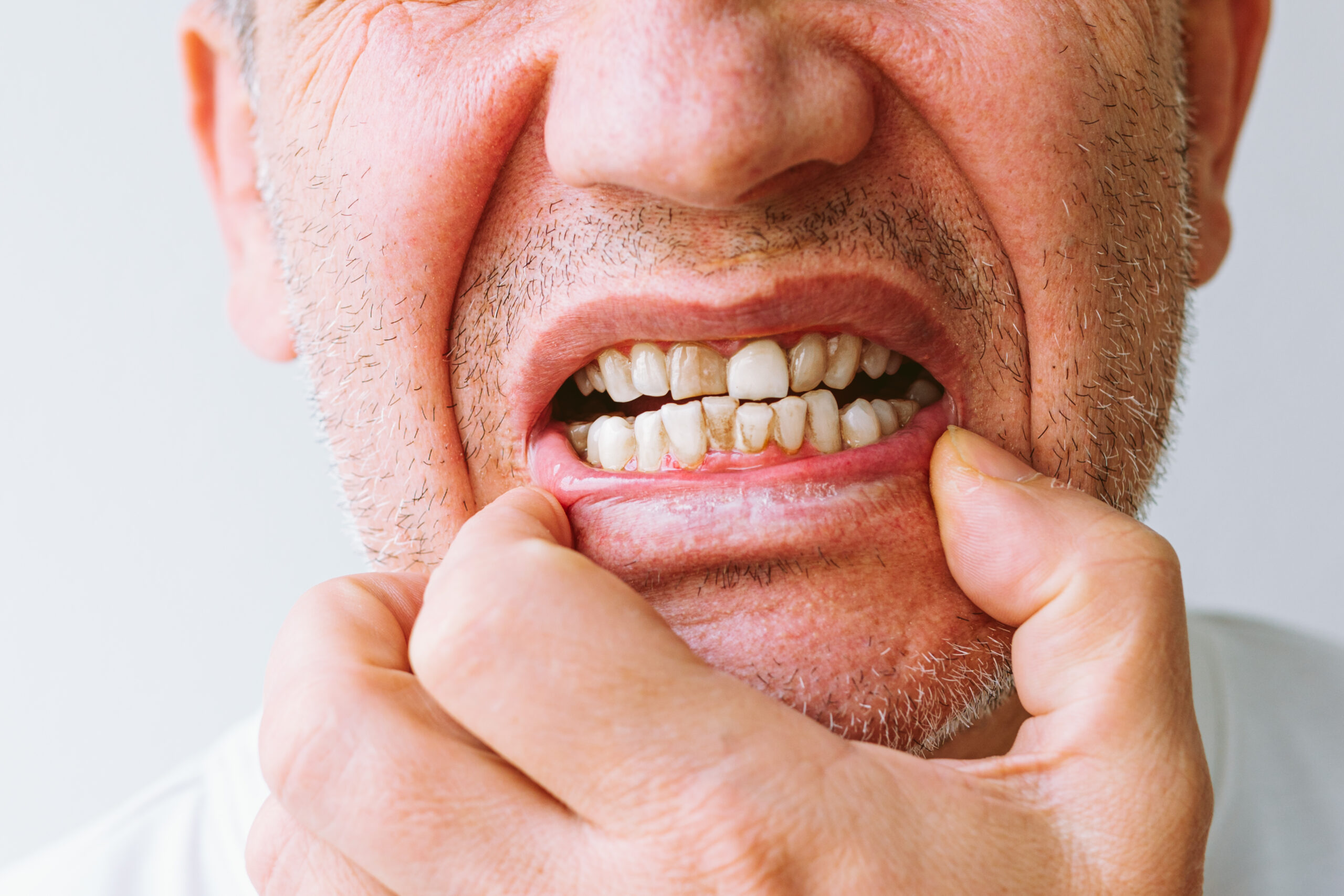 Close-up of a man showing dark stains and tartar buildup on teeth, illustrating visible tooth discoloration and spots