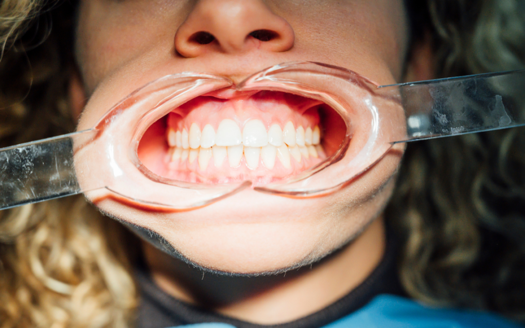 How Does Smoking Affect Gum Disease Treatment and Healing?